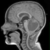 47A Astrocytoma, pilocytic (Case 47) T1 - Copy