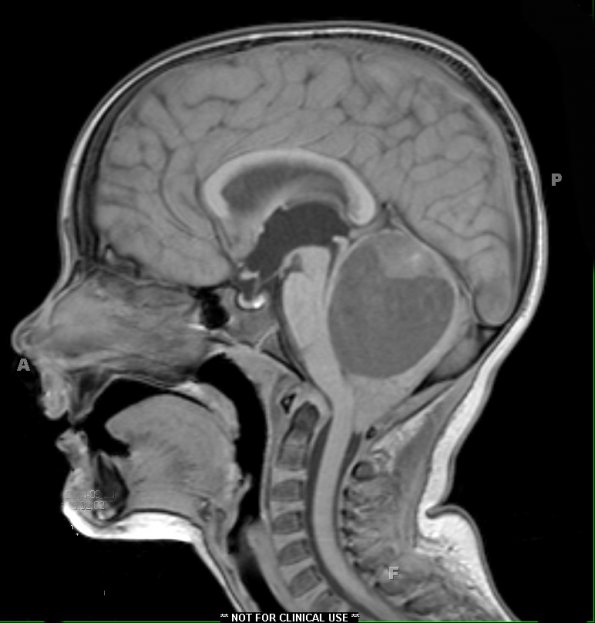 47A Astrocytoma, pilocytic (Case 47) T1 - Copy