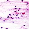 47B1 Astrocytoma, pilocytic (Case 47) H&E 12