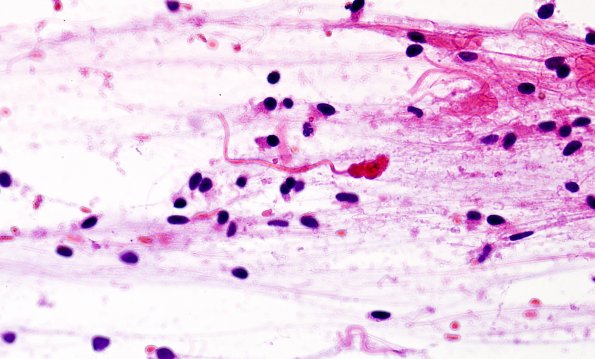 47B1 Astrocytoma, pilocytic (Case 47) H&E 12