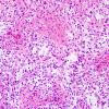 47B2 Astrocytoma, pilocytic (Case 47) H&E 1