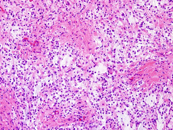 47B2 Astrocytoma, pilocytic (Case 47) H&E 1