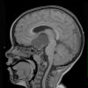 48A1 Astrocytoma, pilocytic (Case 48) T1 - Copy