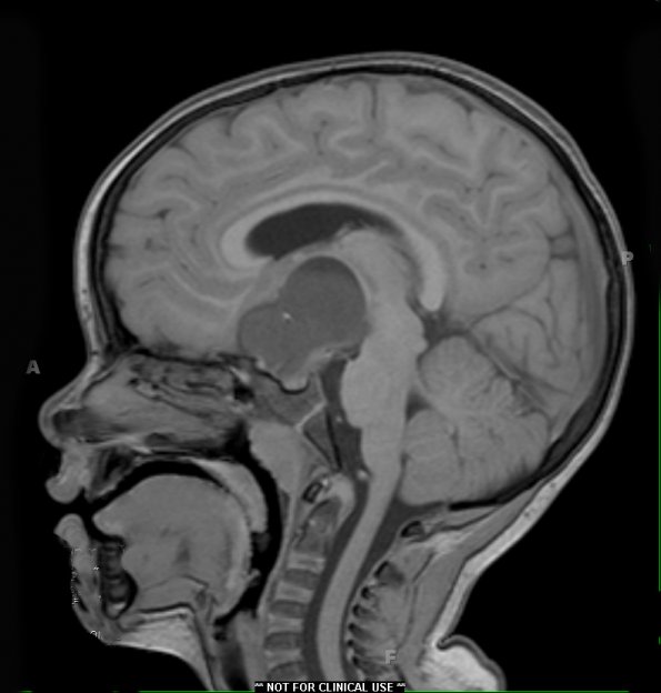 48A1 Astrocytoma, pilocytic (Case 48) T1 - Copy