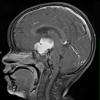 48A2 Astrocytoma, pilocytic (Case 48) T1 W 3 - Copy