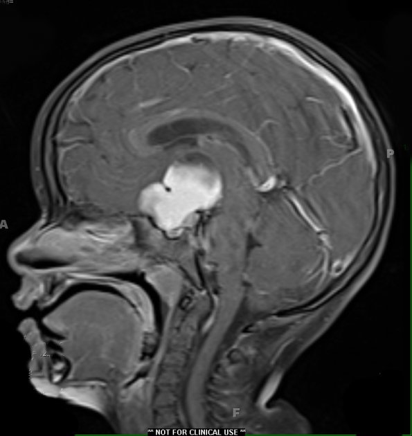 48A2 Astrocytoma, pilocytic (Case 48) T1 W 3 - Copy