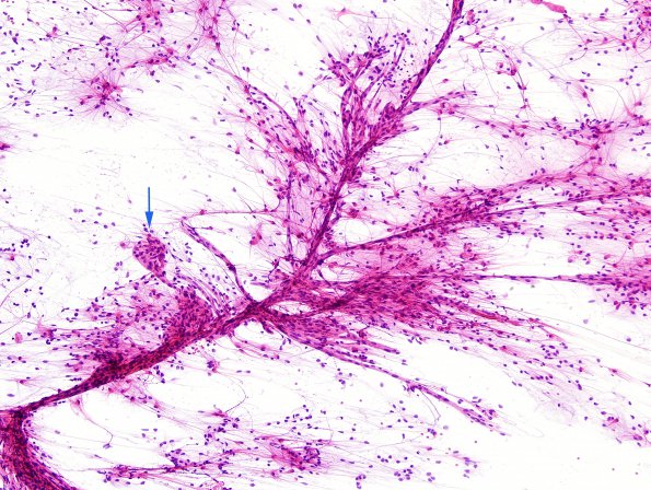 48B1 Astrocytoma, pilocytic (Case 48) H&E smear 2 copy