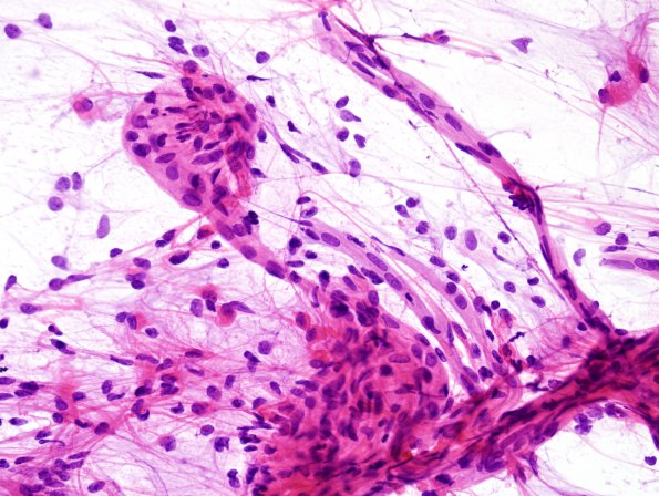 48B2 Astrocytoma, pilocytic (Case 48) H&E smear 3.