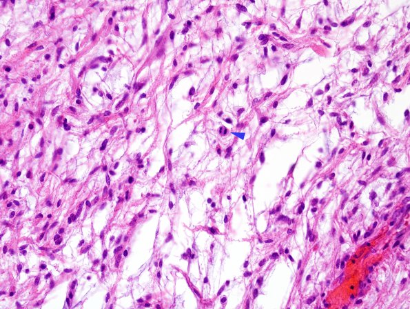 48B3 Astrocytoma, pilocytic (Case 48) H&E 2 copy