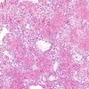 Astrocytoma, pilocytic - Microscopic