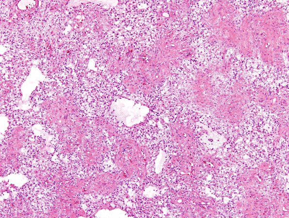 49A Astrocytoma, pilocytic (Case 49) H&E 10X