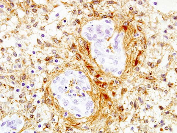 49B Astrocytoma, pilocytic (Case 49) GFAP 60X