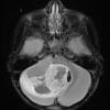 4A1 Astrocytoma, pilocytic (70 yo, Case 4) FLAIR 1 - Copy - Copy