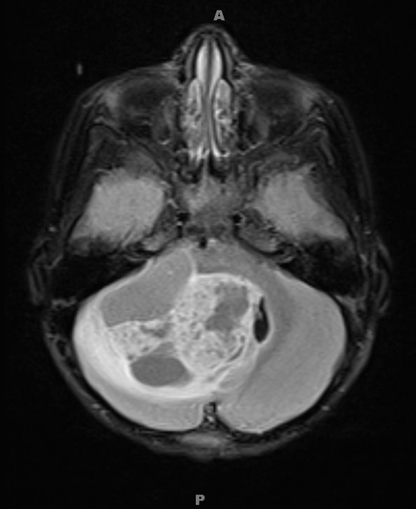 4A1 Astrocytoma, pilocytic (70 yo, Case 4) FLAIR 1 - Copy - Copy