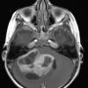 4A2 Astrocytoma, pilocytic (70 yo, Case 4) T1 W1 - Copy - Copy