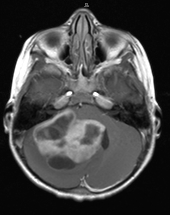 4A2 Astrocytoma, pilocytic (70 yo, Case 4) T1 W1 - Copy - Copy