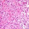 4B2 Astrocytoma, pilocytic (70 yo, Case 4) H&E 1