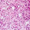 4B3 Astrocytoma, pilocytic (Case 4) H&E 5