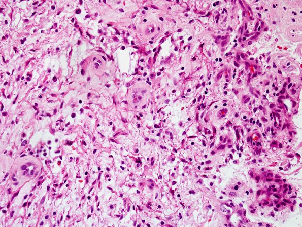 4B3 Astrocytoma, pilocytic (Case 4) H&E 5