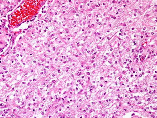 4B4 Astrocytoma, pilocytic (Case 4) H&E 7