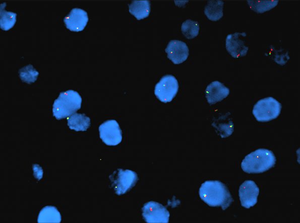 4C Astrocytoma, pilocytic (Case 4) BRAF fusion image - Copy