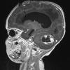 50A0 Astrocytoma, pilocytic (Case 50) T1MPRAGE W - Copy