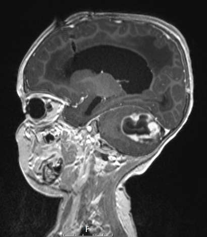 50A0 Astrocytoma, pilocytic (Case 50) T1MPRAGE W - Copy