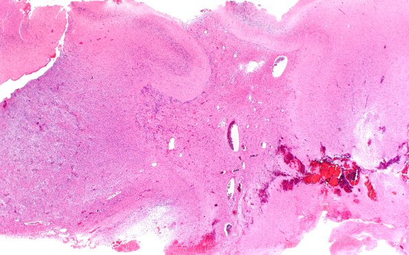 50A1 Astrocytoma, pilocytic (Case 50) H&E 2X