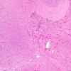 50A2 Astrocytoma, pilocytic (Case 50) H&E 4X 2