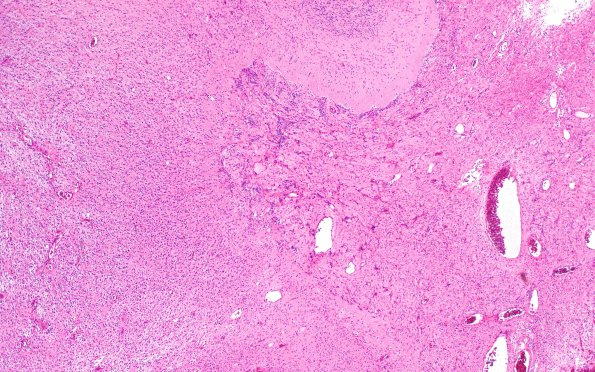 50A2 Astrocytoma, pilocytic (Case 50) H&E 4X 2