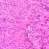 50A4 Astrocytoma, pilocytic (Case 50) H&E 40X