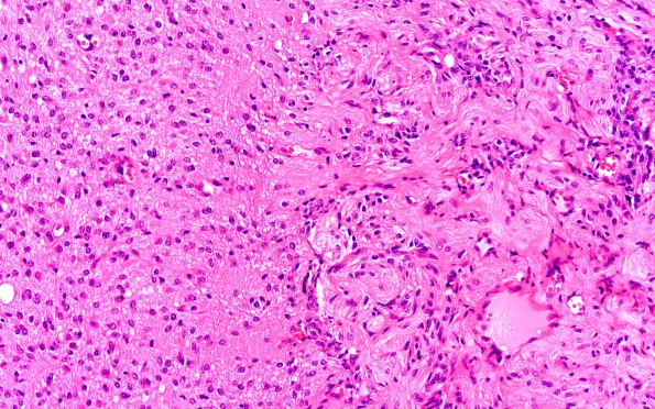 50A4 Astrocytoma, pilocytic (Case 50) H&E 40X