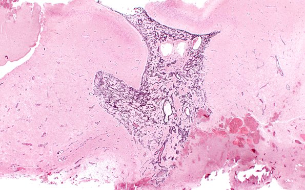 50B1 Astrocytoma, pilocytic (Case 50) Retic 2X