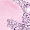 50B2 Astrocytoma, pilocytic (Case 50) Retic 4X