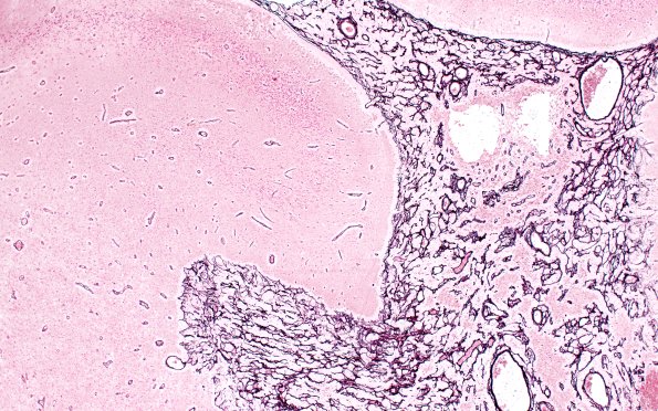 50B2 Astrocytoma, pilocytic (Case 50) Retic 4X