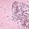 50B3 Astrocytoma, pilocytic (Case 50) Retic 10X