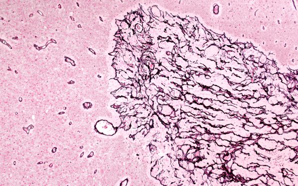 50B3 Astrocytoma, pilocytic (Case 50) Retic 10X