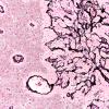 50B4 Astrocytoma, pilocytic (Case 50) Retic 20X