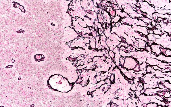 50B4 Astrocytoma, pilocytic (Case 50) Retic 20X