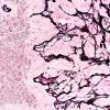 50B5 Astrocytoma, pilocytic (Case 50) Retic 40X