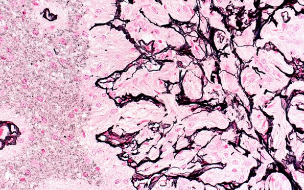 50B5 Astrocytoma, pilocytic (Case 50) Retic 40X