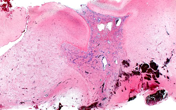 50C1 Astrocytoma, pilocytic (Case 50) TRI 2X