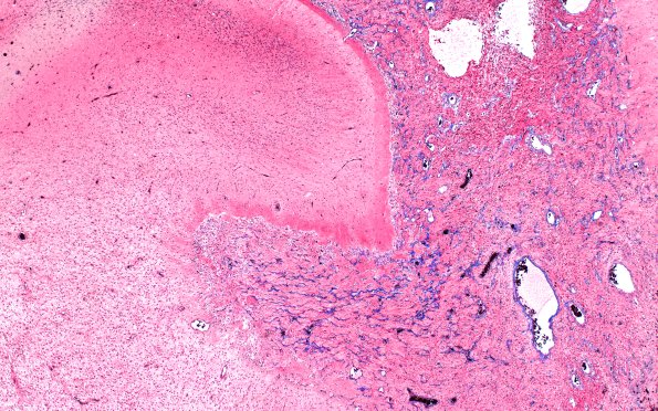 50C2 Astrocytoma, pilocytic (Case 50) TRI 4X