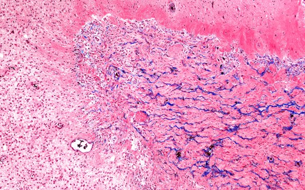 50C3 Astrocytoma, pilocytic (Case 50) TRI 10X