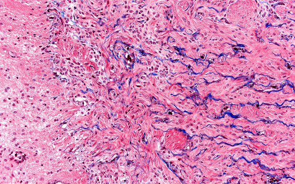 50C4 Astrocytoma, pilocytic (Case 50) TRI 20X