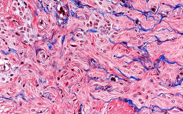 50C5 Astrocytoma, pilocytic (Case 50) TRI 40X