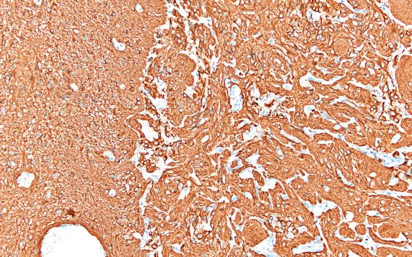 50D3 Astrocytoma, pilocytic (Case 50) GFAP 20X 2