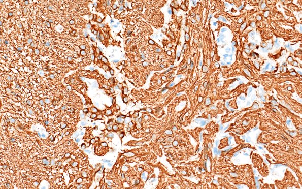 50D4 Astrocytoma, pilocytic (Case 50) GFAP 40X 2