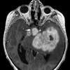 5A1 Astrocytoma, pilocytic (Case 5) MPRAGE W - Copy