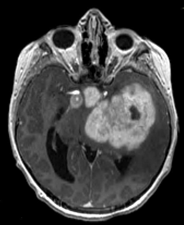 5A1 Astrocytoma, pilocytic (Case 5) MPRAGE W - Copy